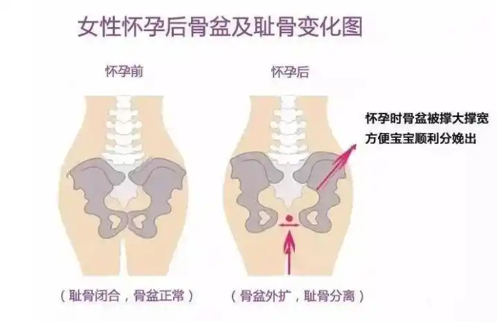 二,为什么要进行骨盆修复?