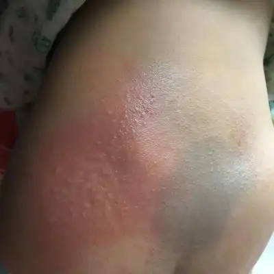 我家宝宝前二天发烧,退烧之后,先是屁股上长了一大片红点,我给她擦了