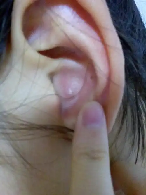 耳朵里有一个硬包,摸起来疼,不碰就不疼