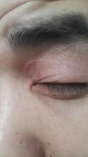 各位大侠看看我眼睛上长的是啥皮肤病?