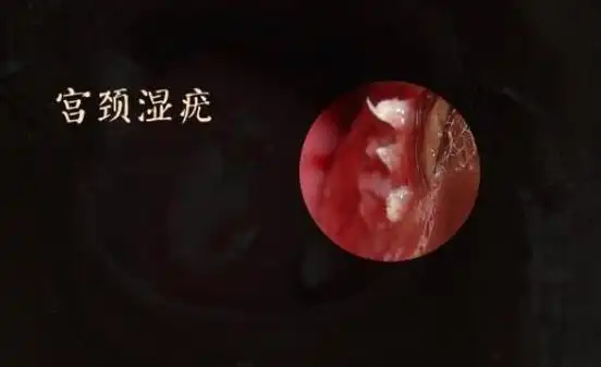 疣体的图片是什么样的