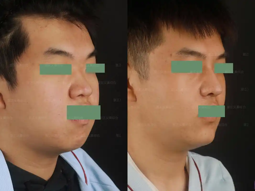 男生小短鼻,山根无转折,鼻梁低,鼻翼宽,鼻基底凹陷,改善重点在于延长