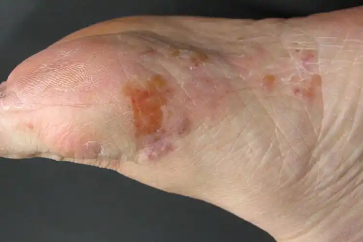 皮癣早期症状图片_有来医生