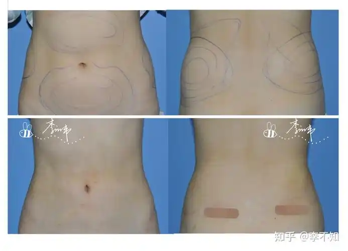 腰腹环吸快速减肥塑型的好方法