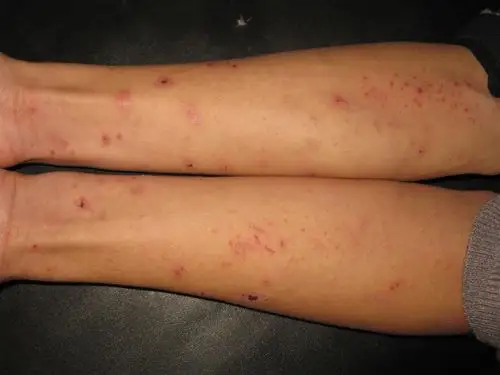 看图识病---------疥疮