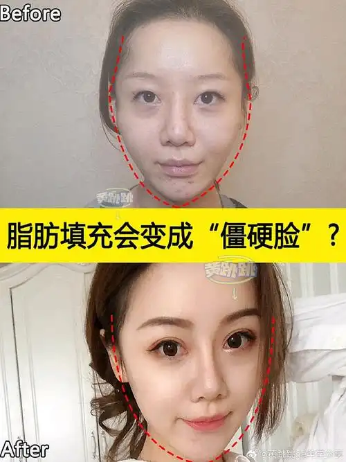 跳跳的攻略#成都脂肪填充哪家比较好?