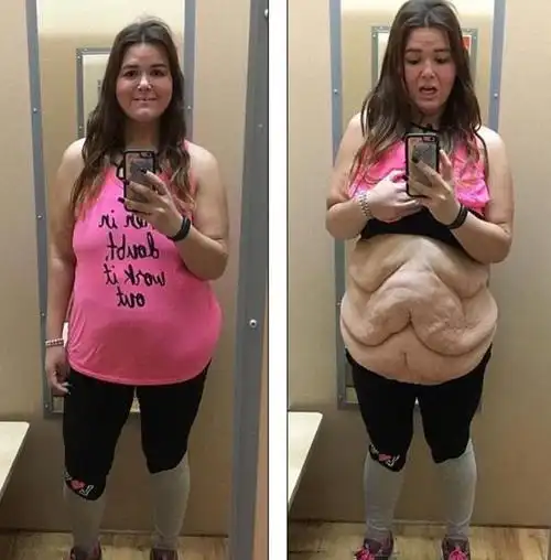 减肥会导致皮肤下垂,人显得衰老吗?