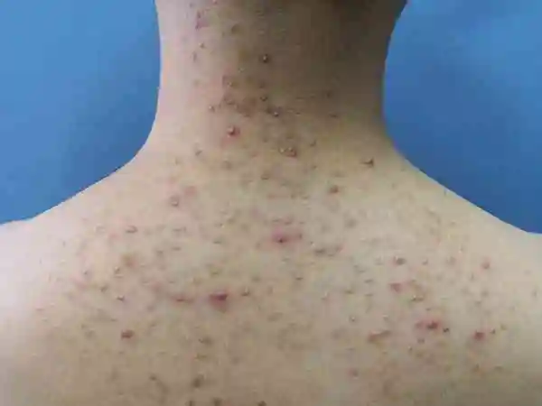 颈部出现2-4mm的小脓疱是糠秕孢子菌性毛囊炎吗?