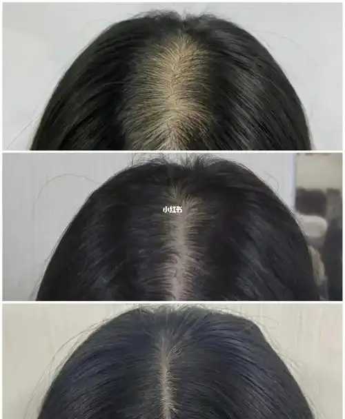 谁说生发难!_养发_生发_发缝稀疏_医疗健康_医疗健康其他