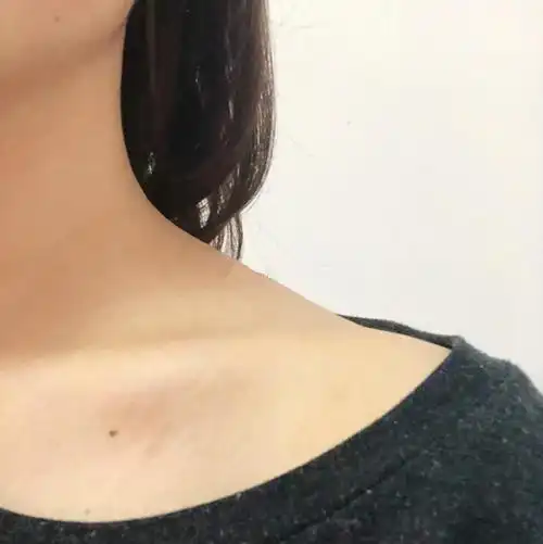 斜方肌过于发达,会显得脖子又短又粗男生可能会很想拥有,但是女生却是