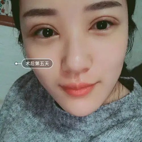 青岛割的平扇形双眼皮,太好看了吧