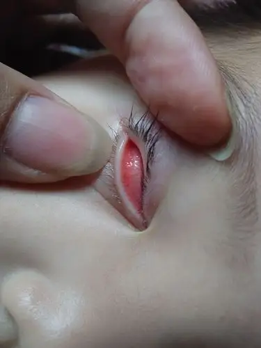 宝宝十五个月一周,下眼皮内有红血丝长了透明的类似水泡状物,有图,问