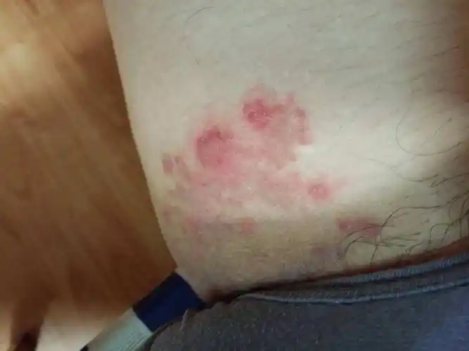 股癣专家_治疗股癣哪个专家好_治疗股癣最好的专家/排行_有来医生