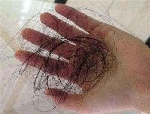 北京月子中心告诉您产后脱发应该怎么办