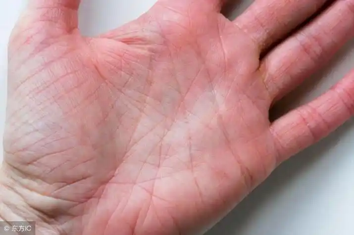 手纹看病掌纹看病大揭秘