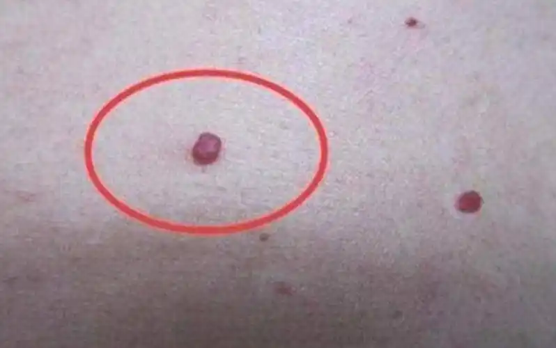 身上出现红痣图片 (第1页)