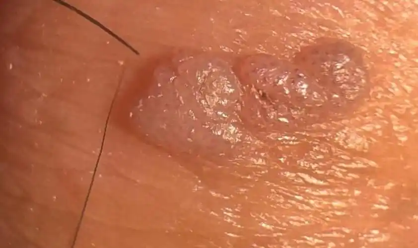 hpv长疣体什么样子的图片