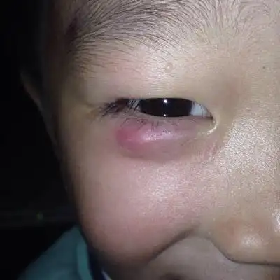 宝宝眼睛下面长了这个东西是什麼,有没有宝妈知道的,医生说是散力肿该