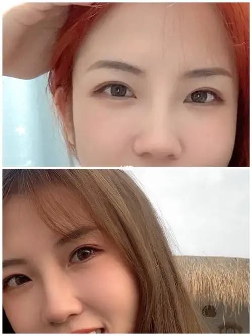 术前单眼皮90术后双眼皮(对比篇)_双眼皮_单眼皮_双眼皮贴_全切双