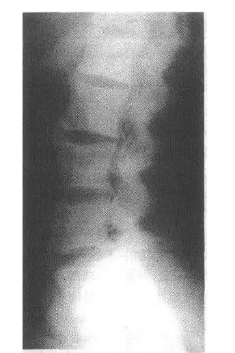 人体腰椎ct图谱医学影像图