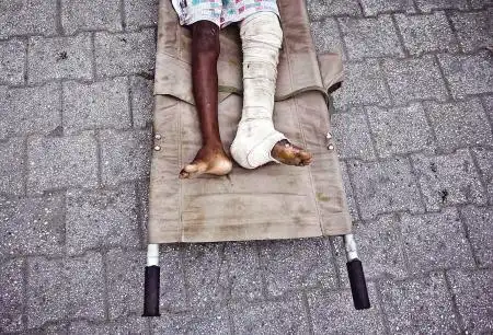 强震让当地数以万计的民众肢体残缺,海地未来将必须面对"截肢的一代"