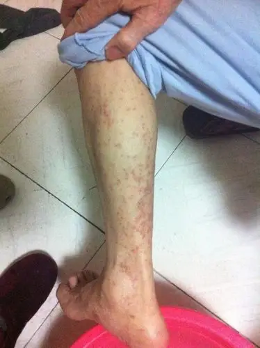 87岁老人全身都起这样的疙瘩 特别痒 有人知道这是什么吗