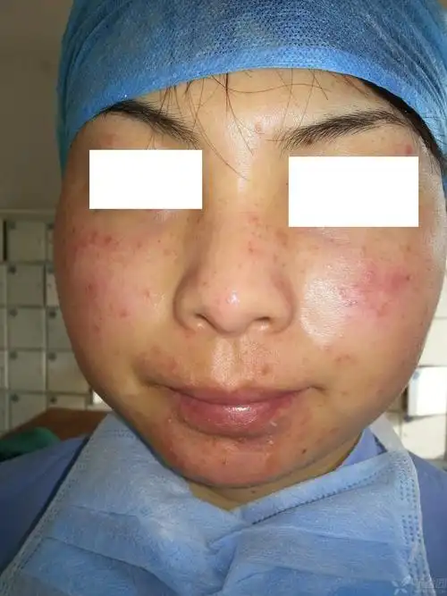 部红斑,水泡,渗出,伴有刺痛,自行诊断:单纯疱疹,给予阿昔洛韦软膏外用