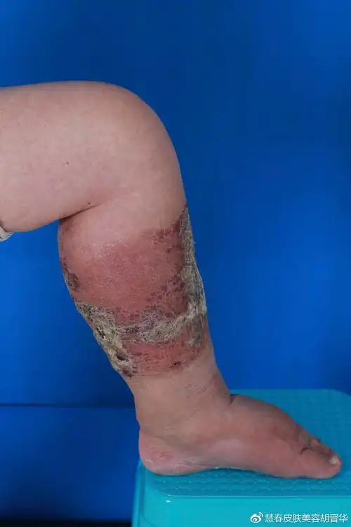 慢性复发性丹毒继发小腿象皮肿一例