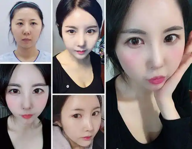 韩国ynt整形外科脂肪填充对比案例