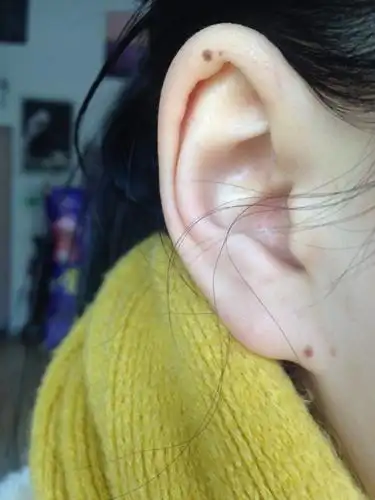 耳朵长痣好吗?面相上怎么解释,第一张是左耳朵.第二张是右耳朵