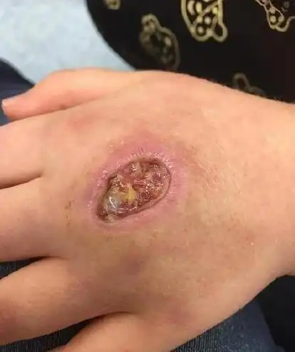 被蜘蛛咬了伤口图片