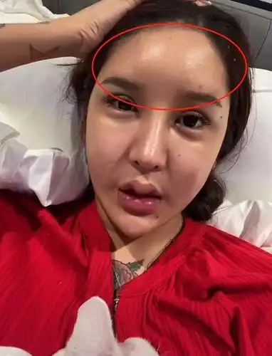 女网红晒整容失败视频,眼睛睁不开,嘴肿成"嘟嘟唇"