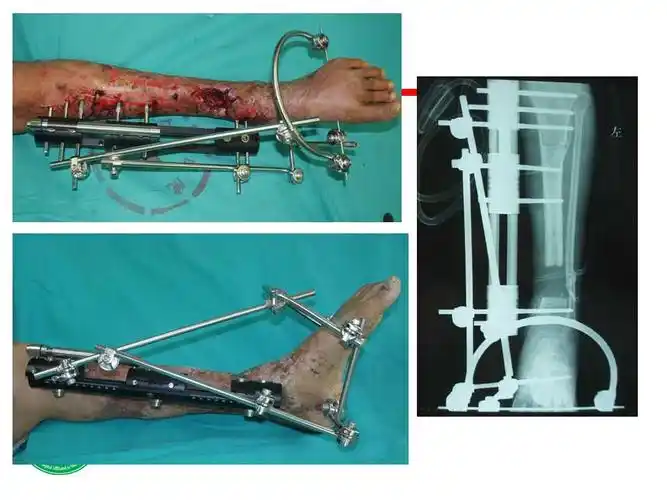 小腿软组织缺损的骨外固定治疗
