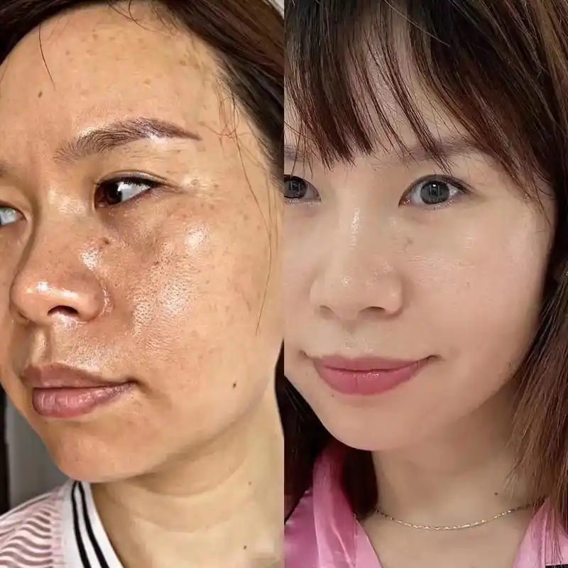 各种皮肤问题,激素脸,痘痘肌,斑点的调理反馈:↓↓↓奢悦国民 - 抖音