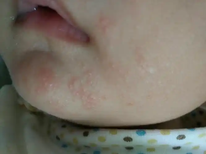 婴儿脂溢性皮炎怎么处理宝宝三个月加15天大