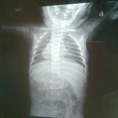 新生儿30天得肺炎,现在在妇幼icu,这是胸片,很严重吗