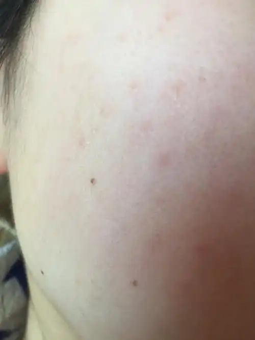 一开始过敏是化妆品,后来过敏控制住了,现在脸不痒,就变成这样了