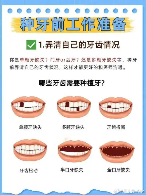 超详细的种植牙攻略6015不看9191