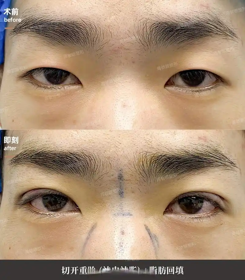 男士双眼皮即刻案例对比 男生双眼皮一定不能宽,要窄和自然,哪怕是有