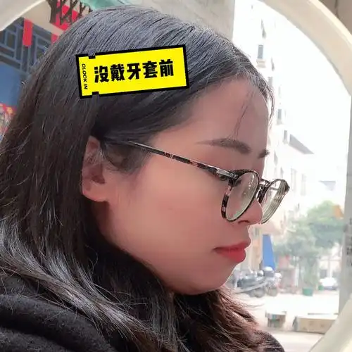 戴牙套侧脸的变化