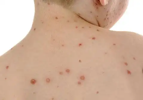 丘疹是什么样子图片