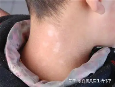 4.单纯糠疹 ("桃花癣""白色糠疹""虫斑")