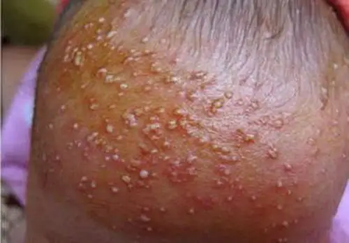 孕妇疥疮初期腹部皮肤症状图片