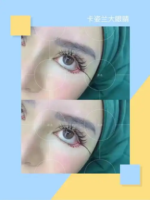 芭比款眼部多项术后即刻,四项全开#做的双眼皮能自然到_圈子-新氧美容