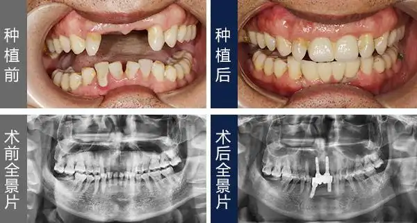 做种植牙需要多久
