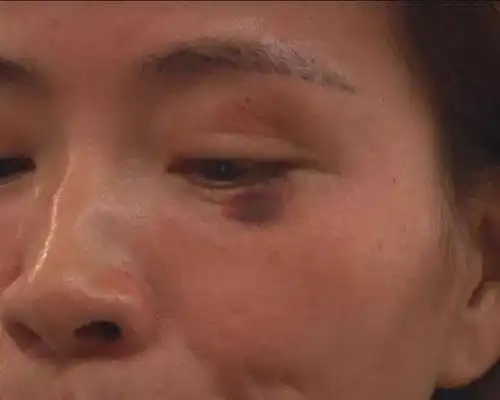 济宁一女士去整容,结果毁容了.多图