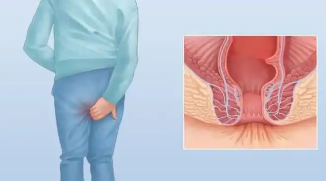 肛门瘙痒怎么办一个方法轻松解决