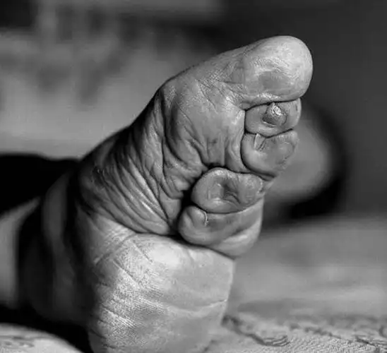 三寸金莲美的代价实拍中国最后的缠足妇女多图高清照