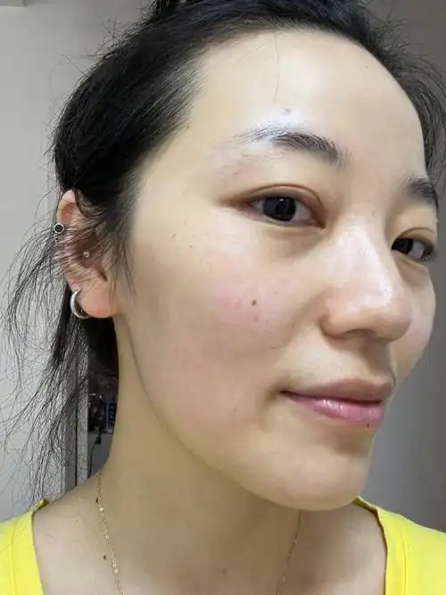 做光子嫩肤之前脸上的干纹细纹还是比较明显的