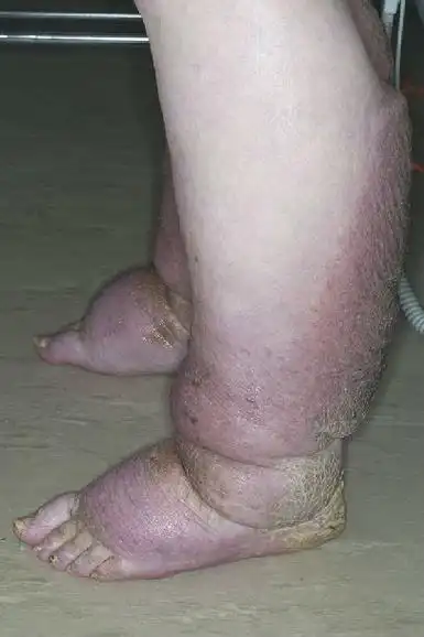 淋巴水肿诊断与治疗原则 - 好大夫在线